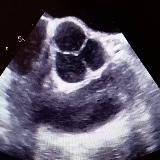 Эхокардиографический блог. Echocardiography blog