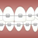 Брекеты и ортодонтия
